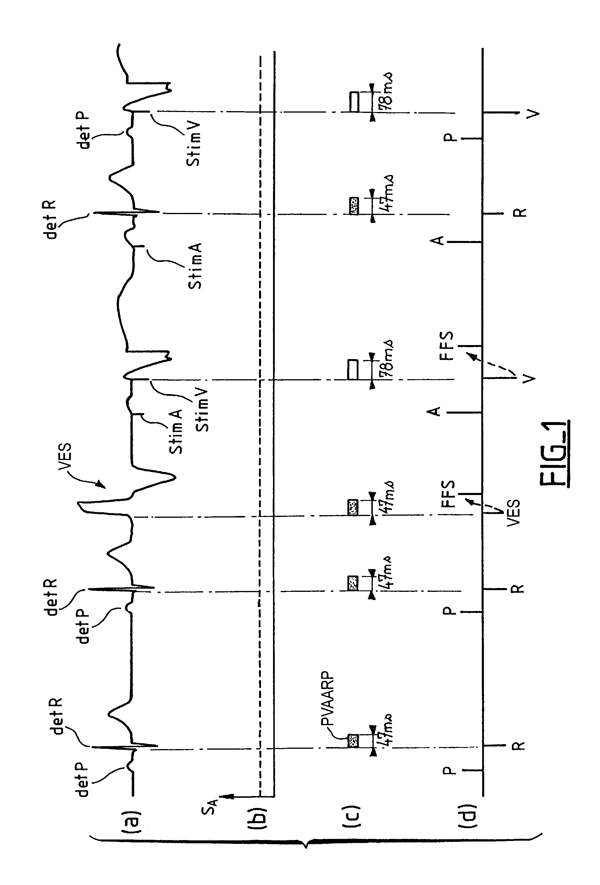 Atrial arrhythmia detection for an active implantable medical device