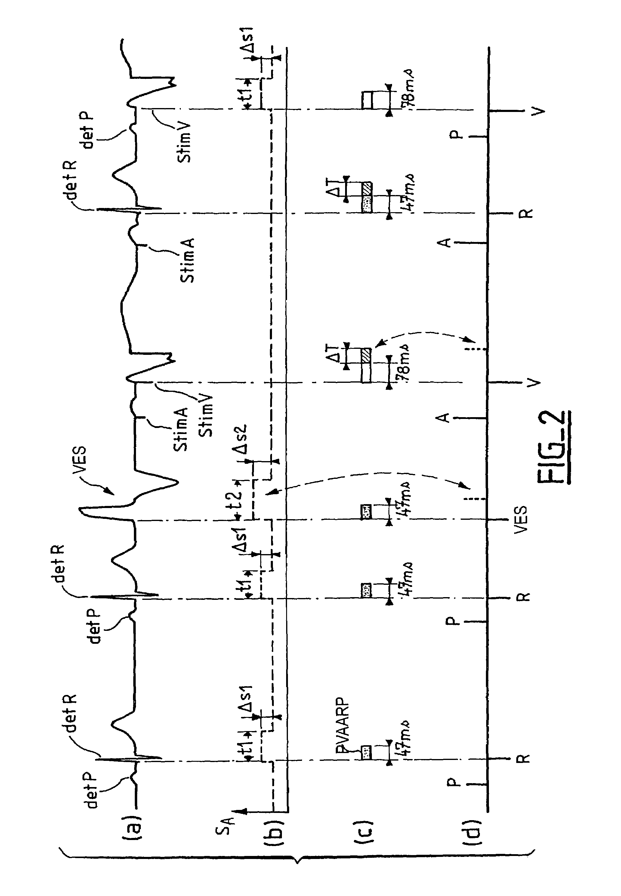 Atrial arrhythmia detection for an active implantable medical device