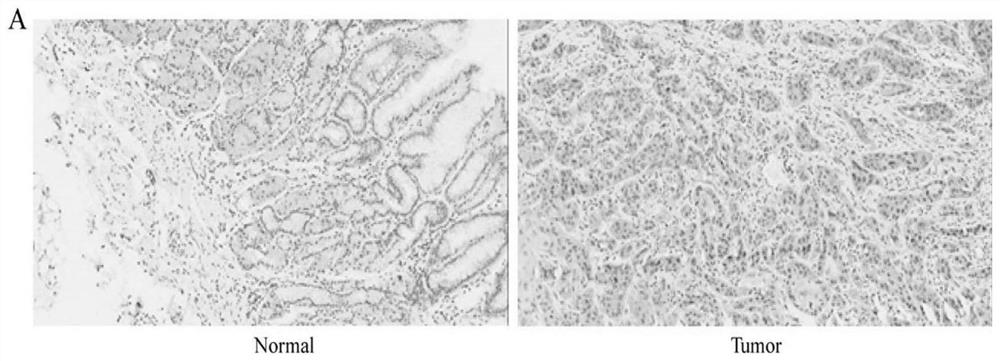 application of PIEZO1 protein as esophageal cancer marker