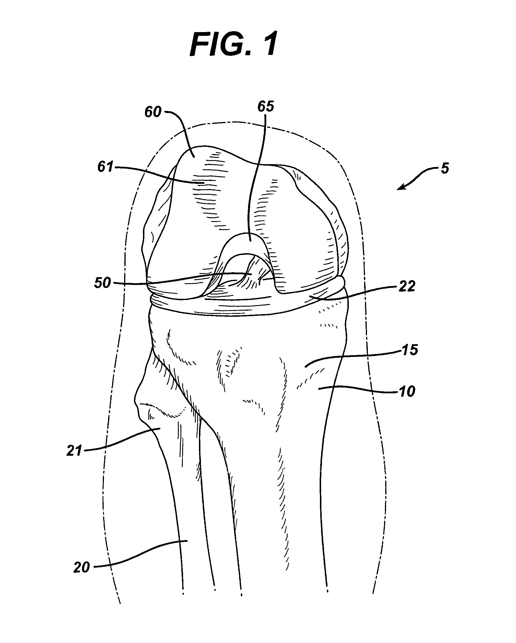 Method of replacing an anterior cruciate ligament in the knee