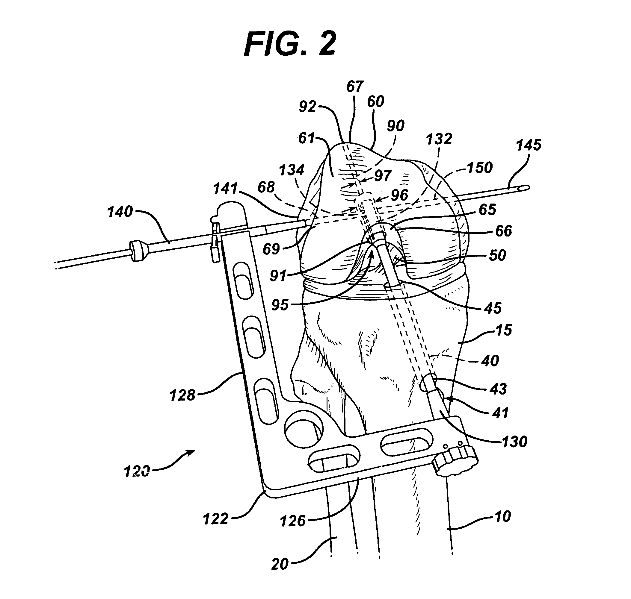 Method of replacing an anterior cruciate ligament in the knee