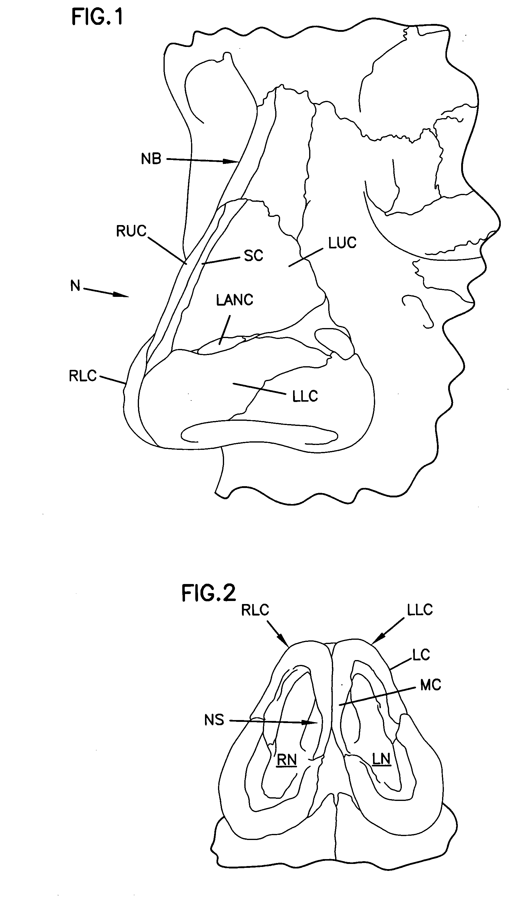 Nasal valve treatment method & apparatus