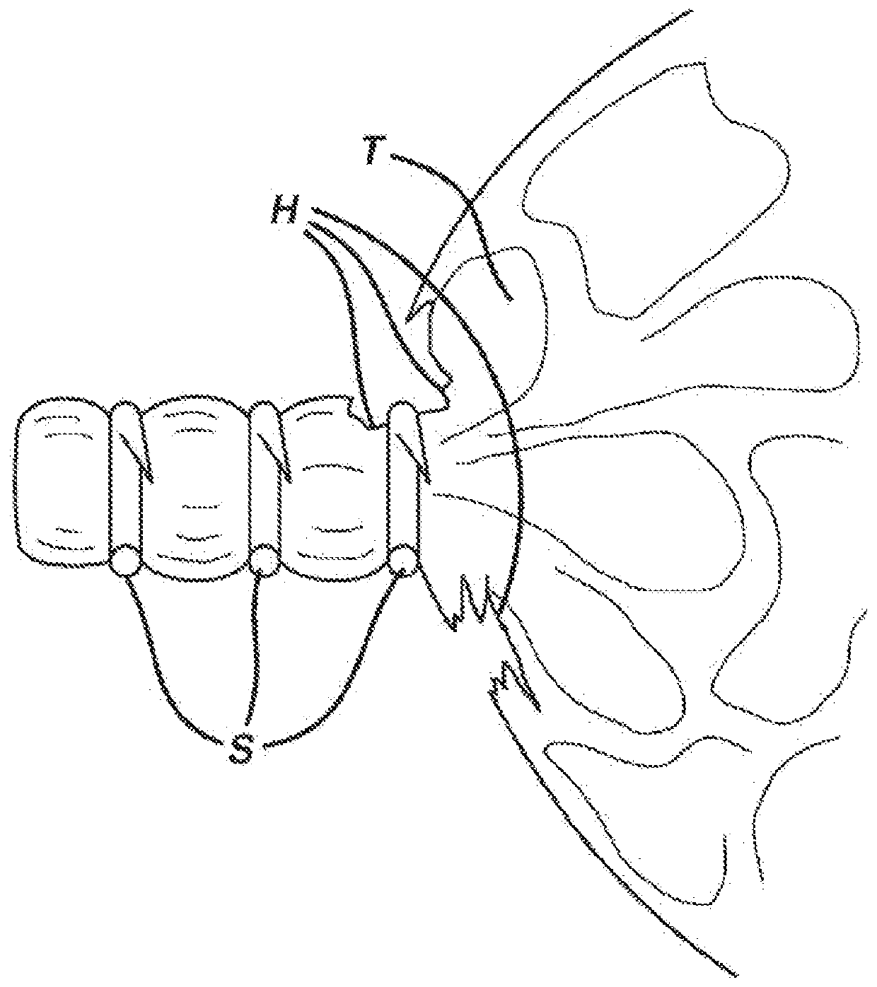 Device for sealing staples in tissue