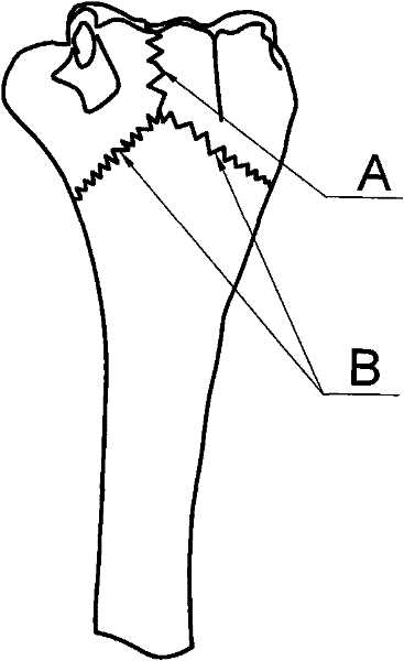 Locking bone fracture plate for far back outer side of humerus