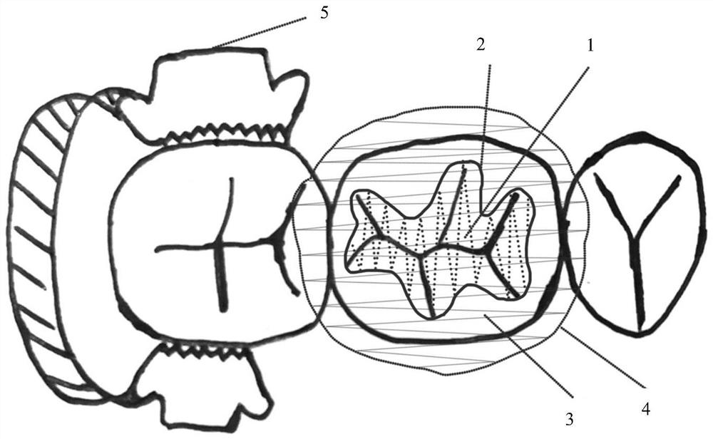 A personalized occlusal surface transparent silicone rubber guide plate and its preparation and method for assisting tooth filling