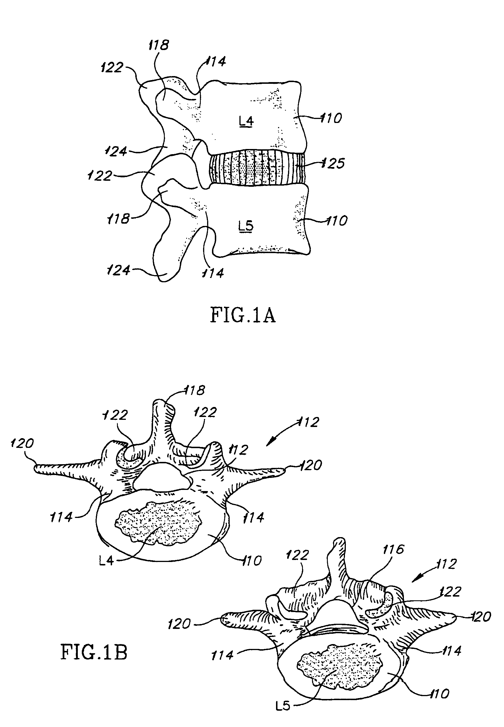 Spinal prostheses