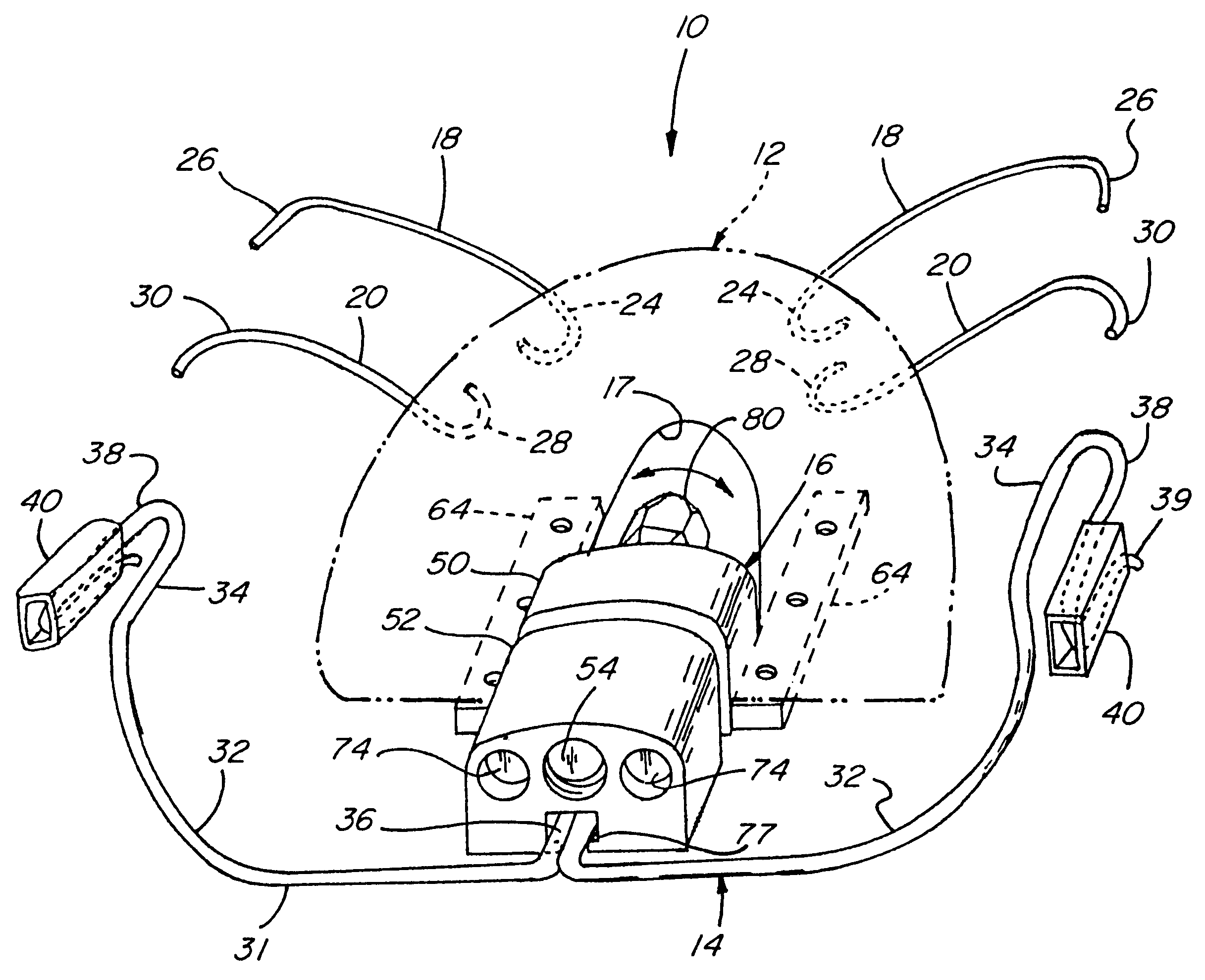 Orthodontic distalizing appliance