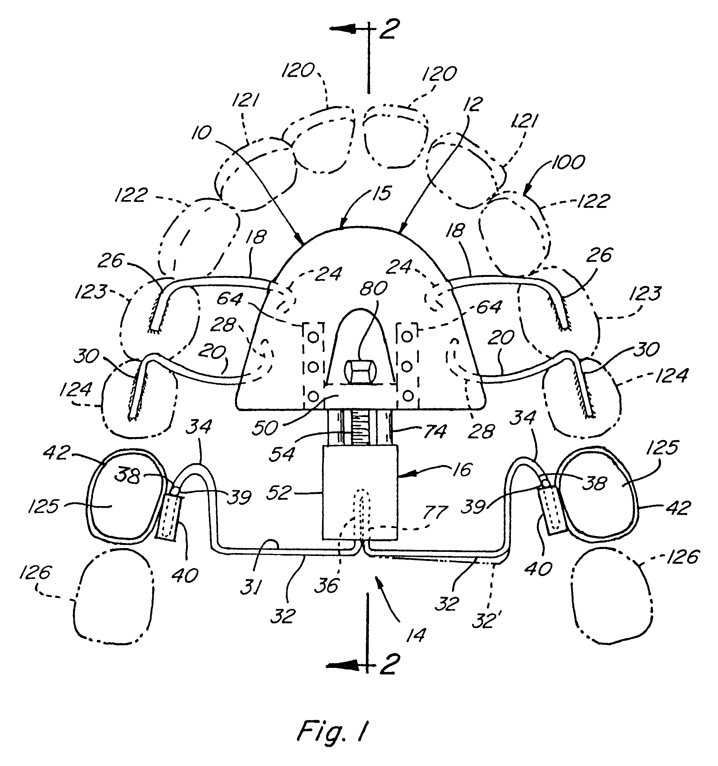 Orthodontic distalizing appliance