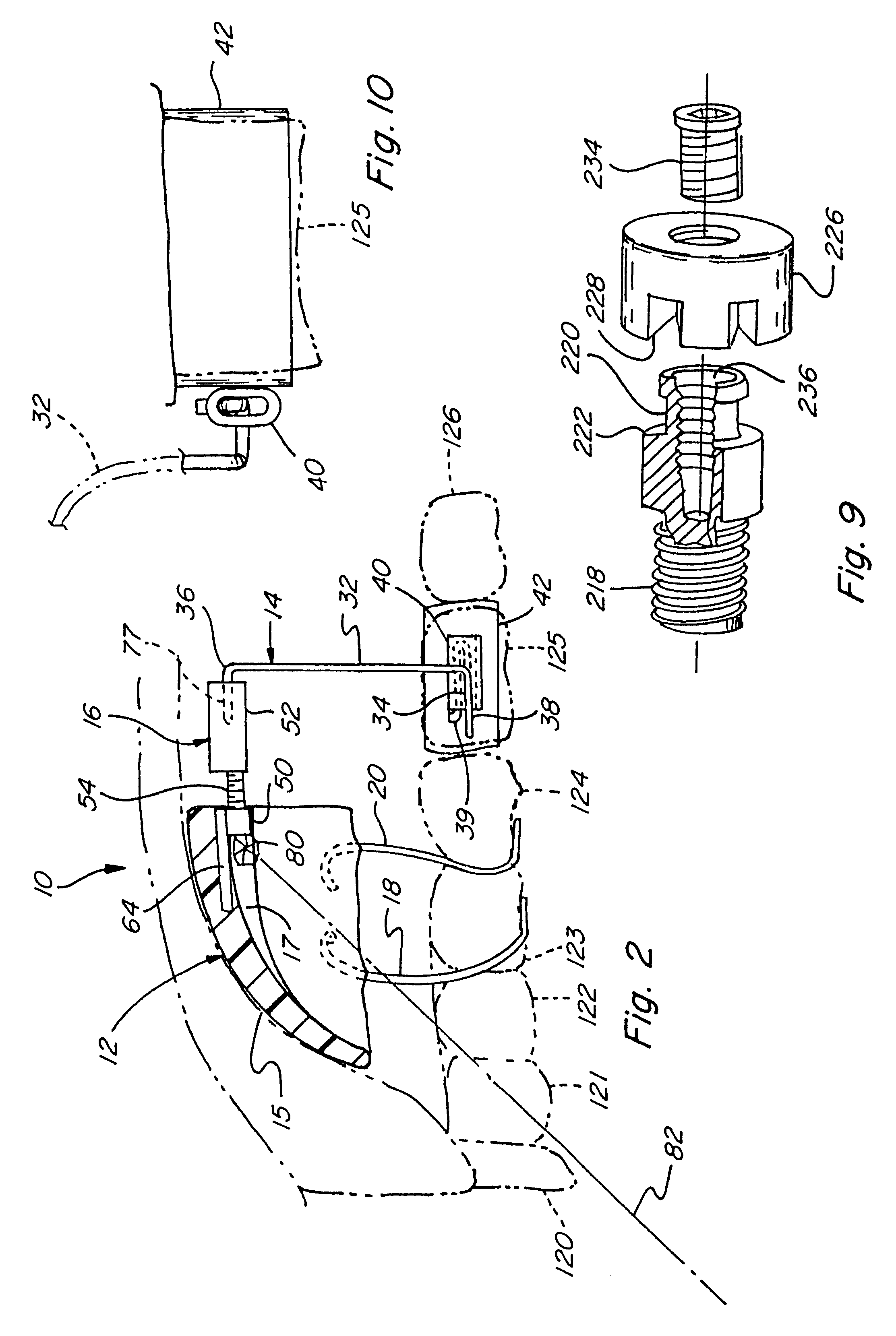 Orthodontic distalizing appliance