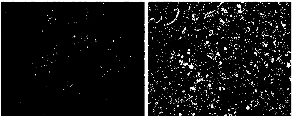 Application of substance taking MANF as target spot in preparing products for treating intrahepatic cholangiocarcinoma