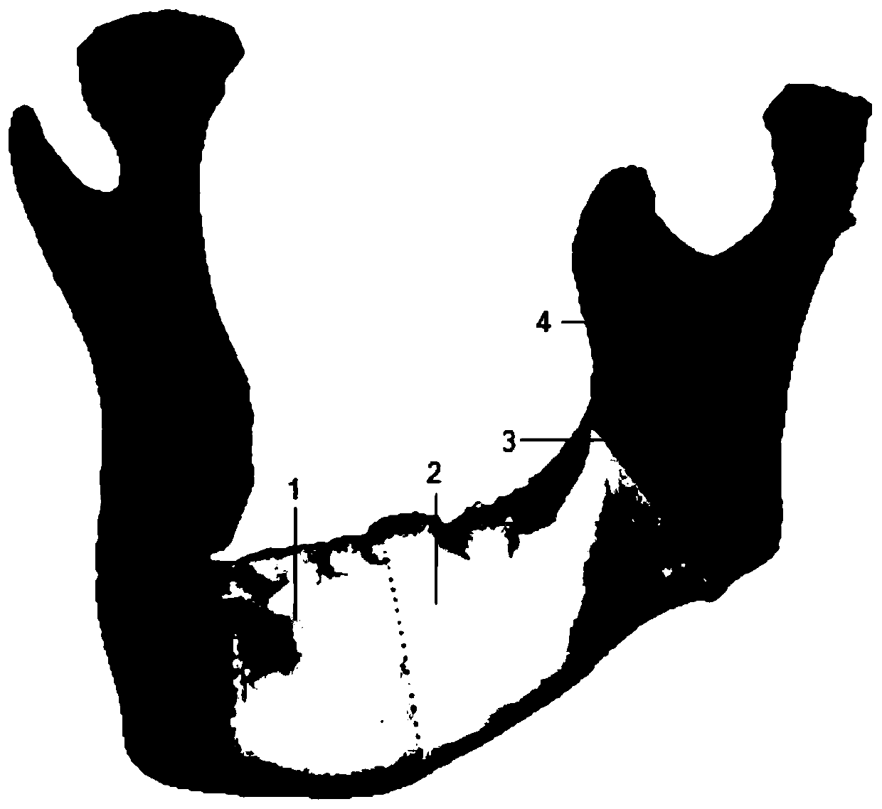 Mandibular position information recording device based on guide plate