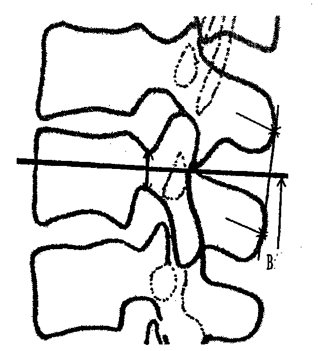 X-ray-film-based method for locating coordinates of pedicle screws