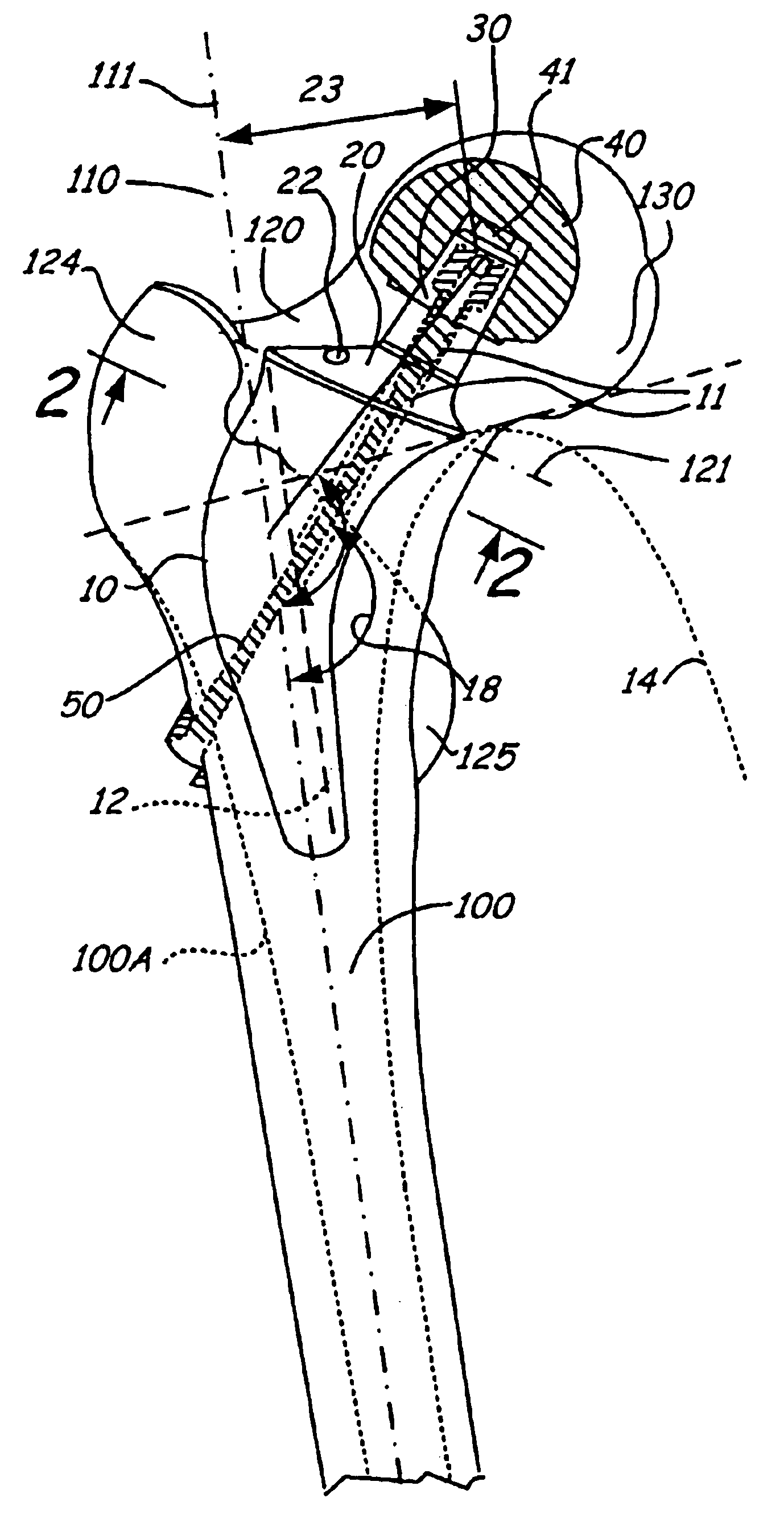 Neck-slip-prosthesis