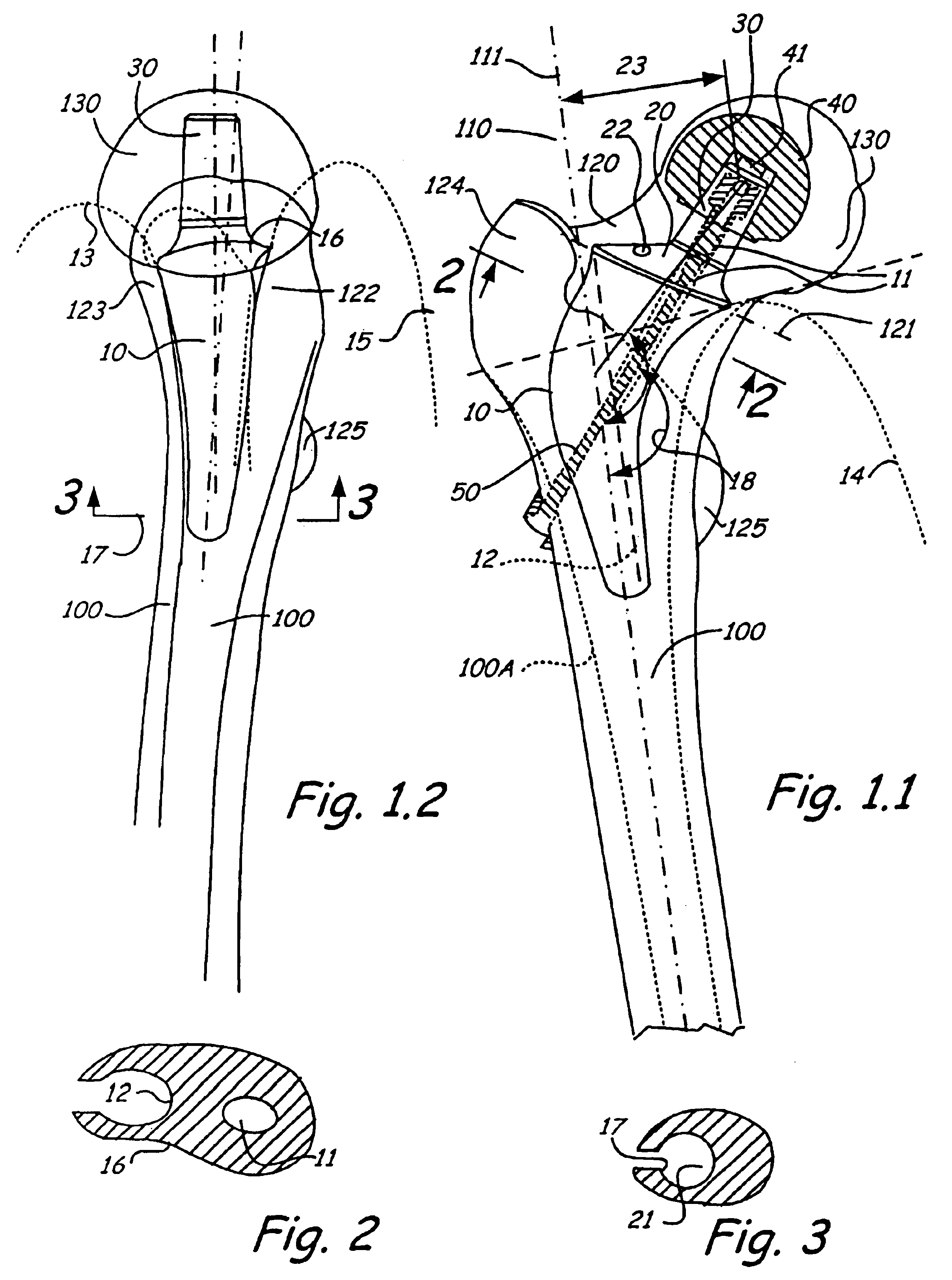 Neck-slip-prosthesis