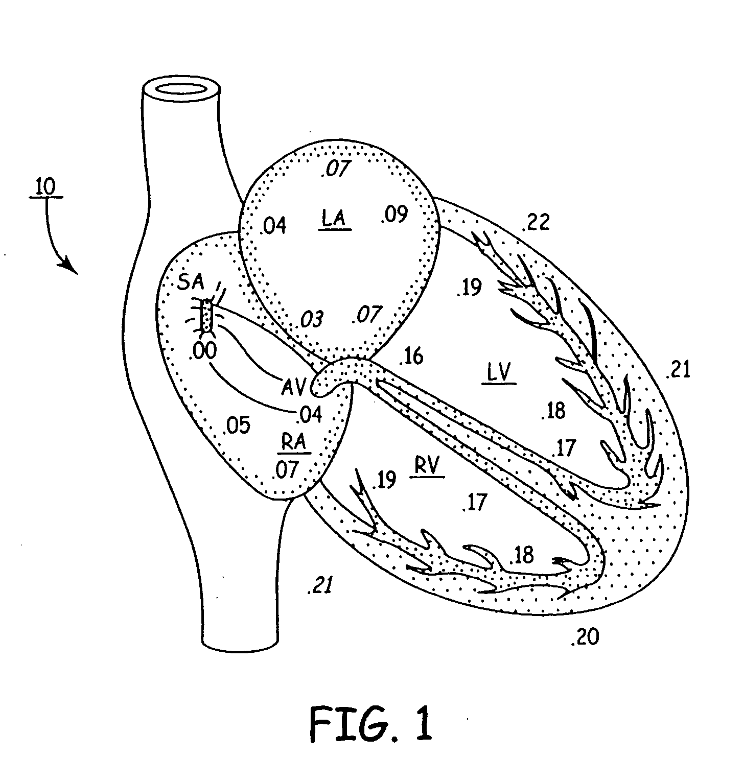 Optimization of AV intervals in single ventricle fusion pacing through electrogram morphology