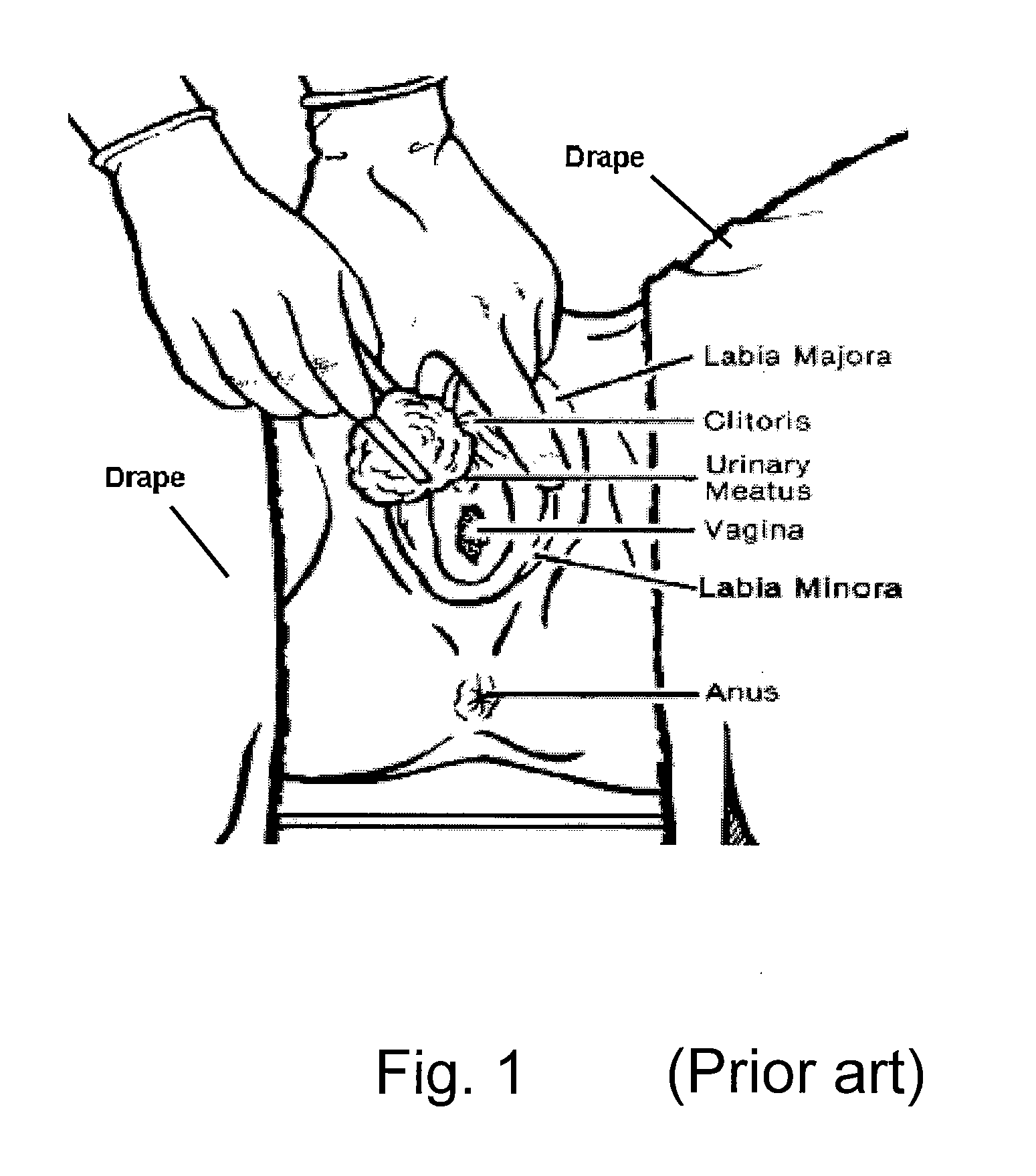 Surgical drape system for urology procedures on female patients