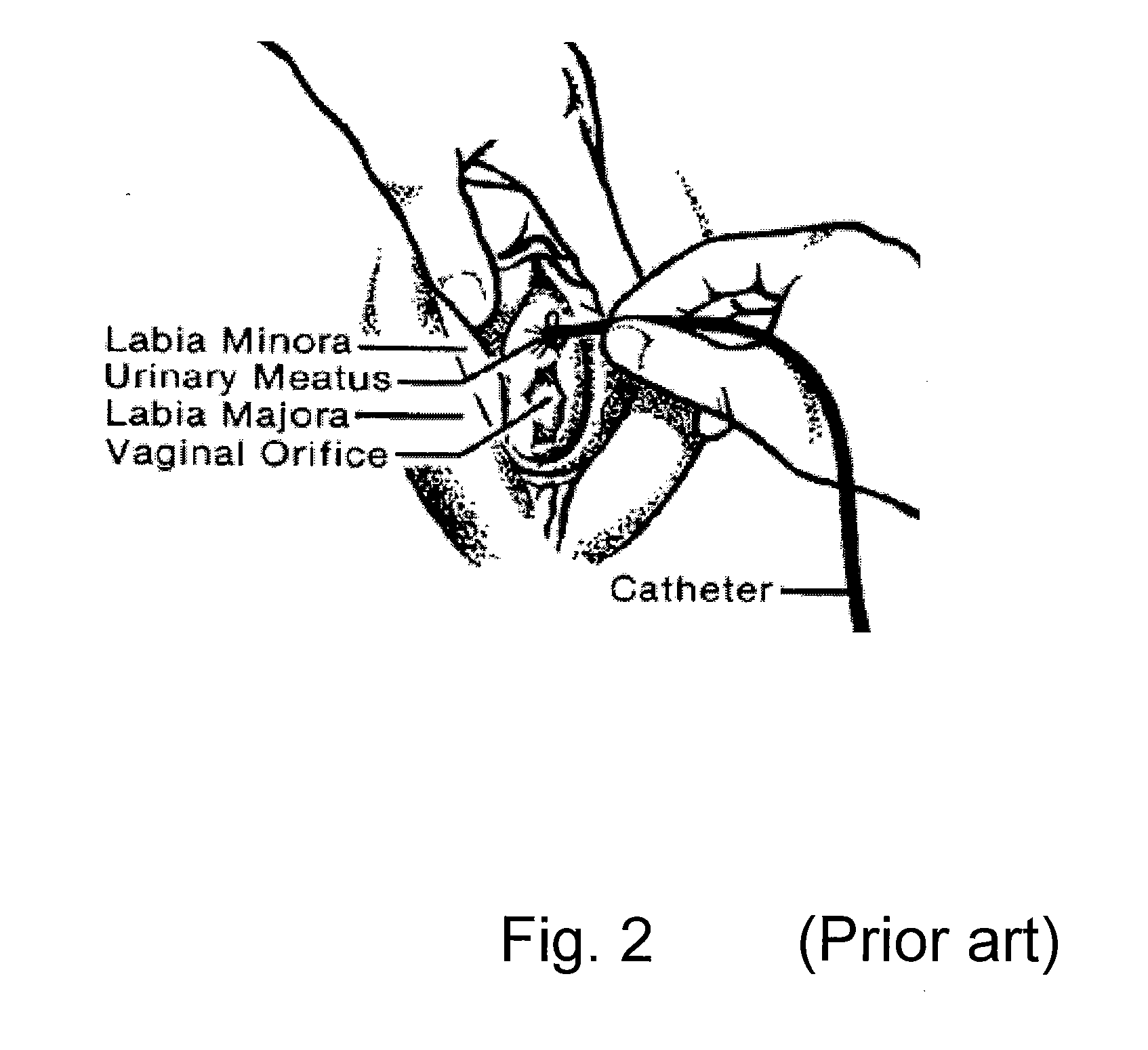 Surgical drape system for urology procedures on female patients