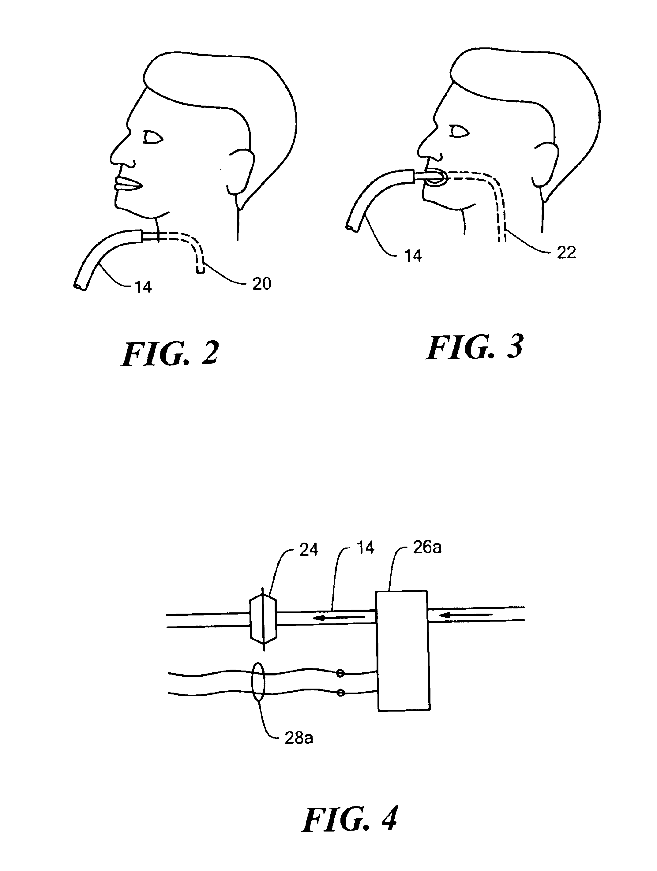 Insufflation-exsufflation system for removal of broncho-pulmonary secretions with automatic triggering of inhalation phase