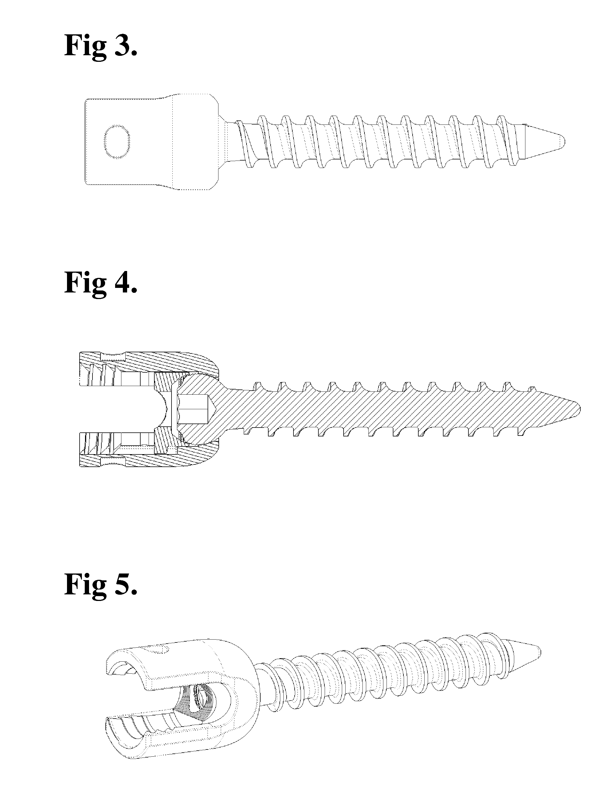 Radiosurgery Compatible Bone Anchor