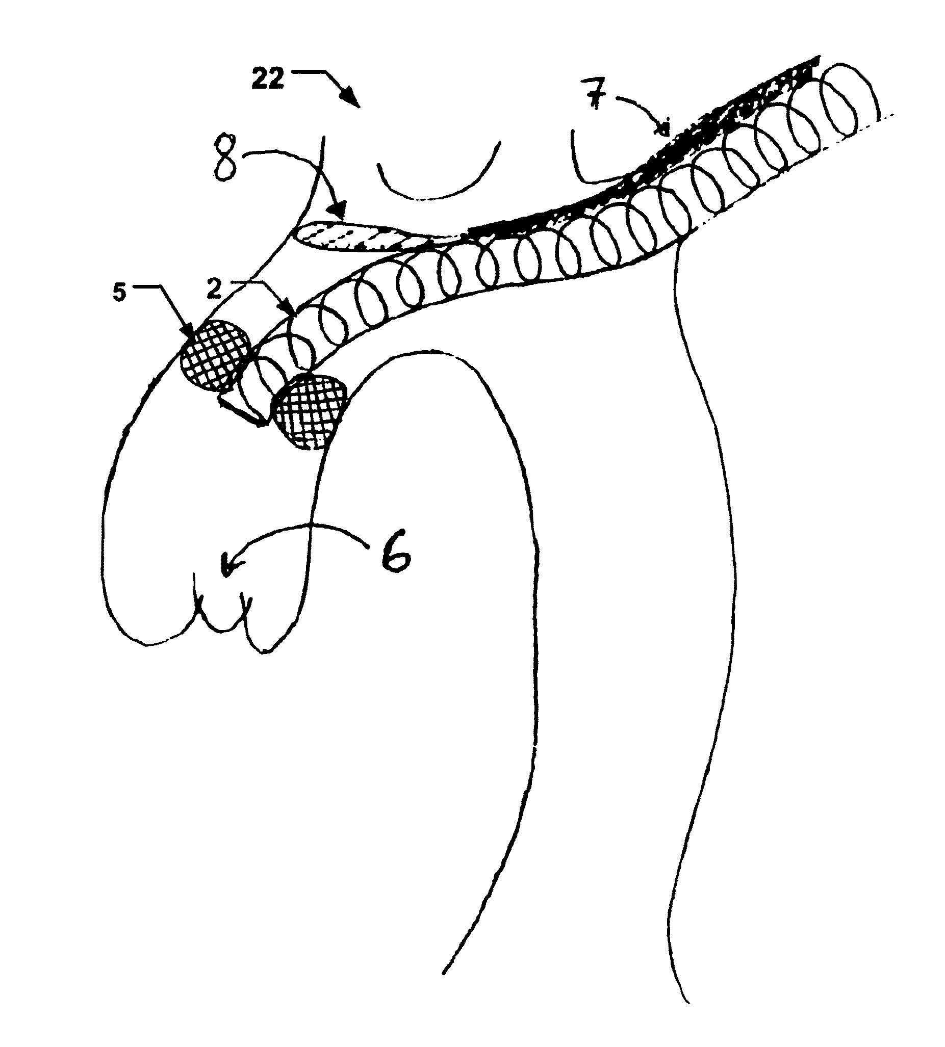 Method for delivery of an embolic protection unit