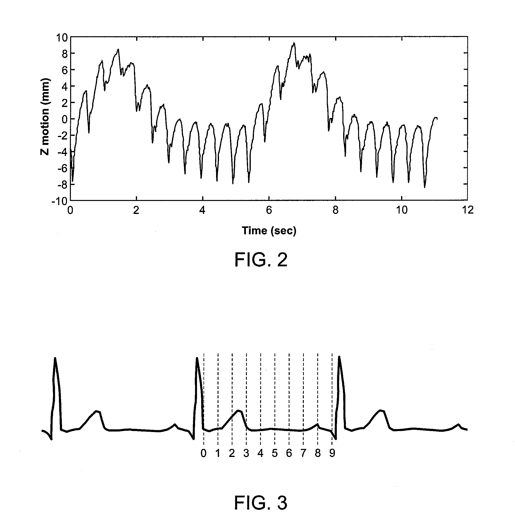 Depositing radiation in heart muscle under ultrasound guidance