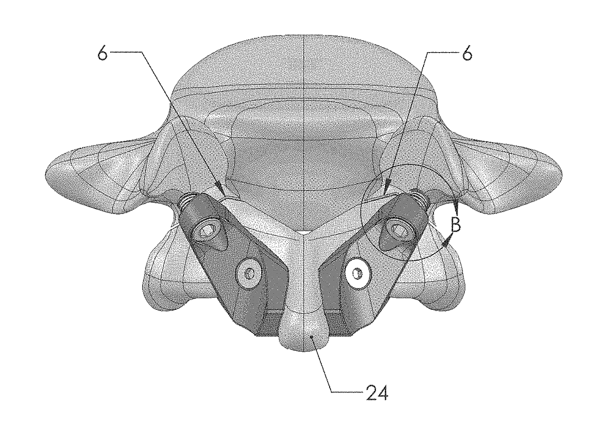 Pars Interarticularis Fracture Device