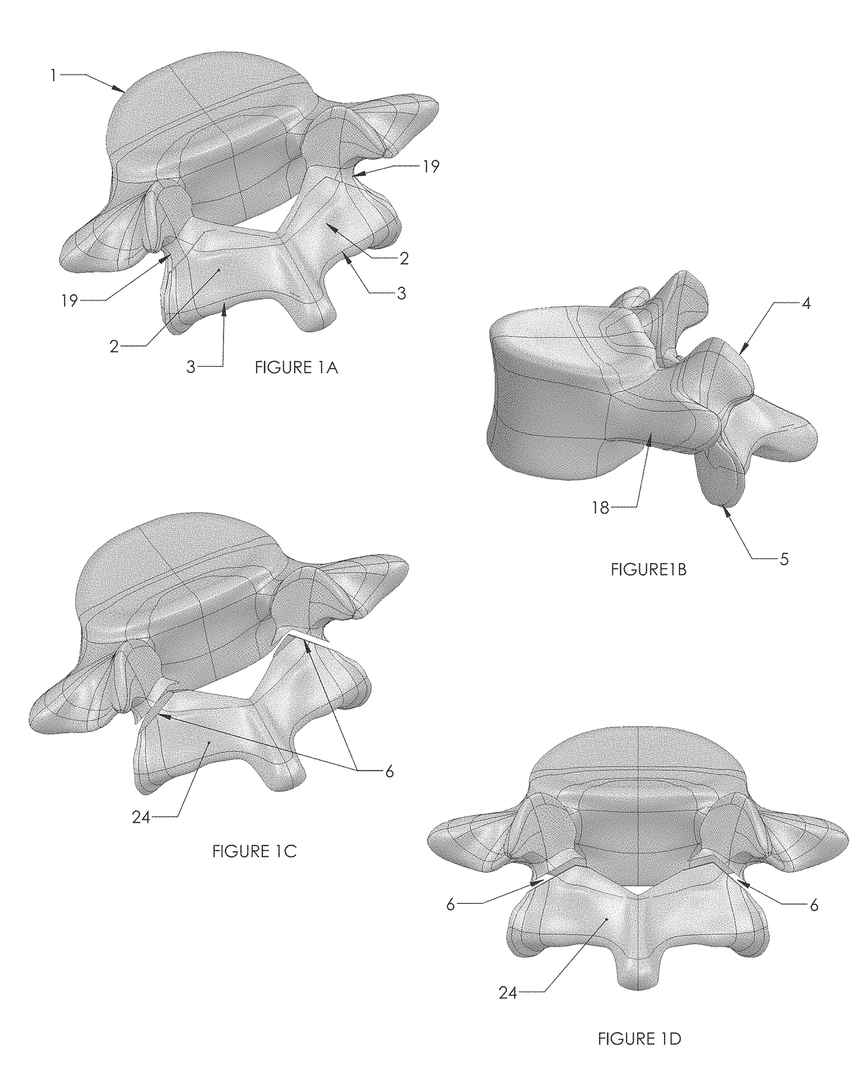 Pars Interarticularis Fracture Device