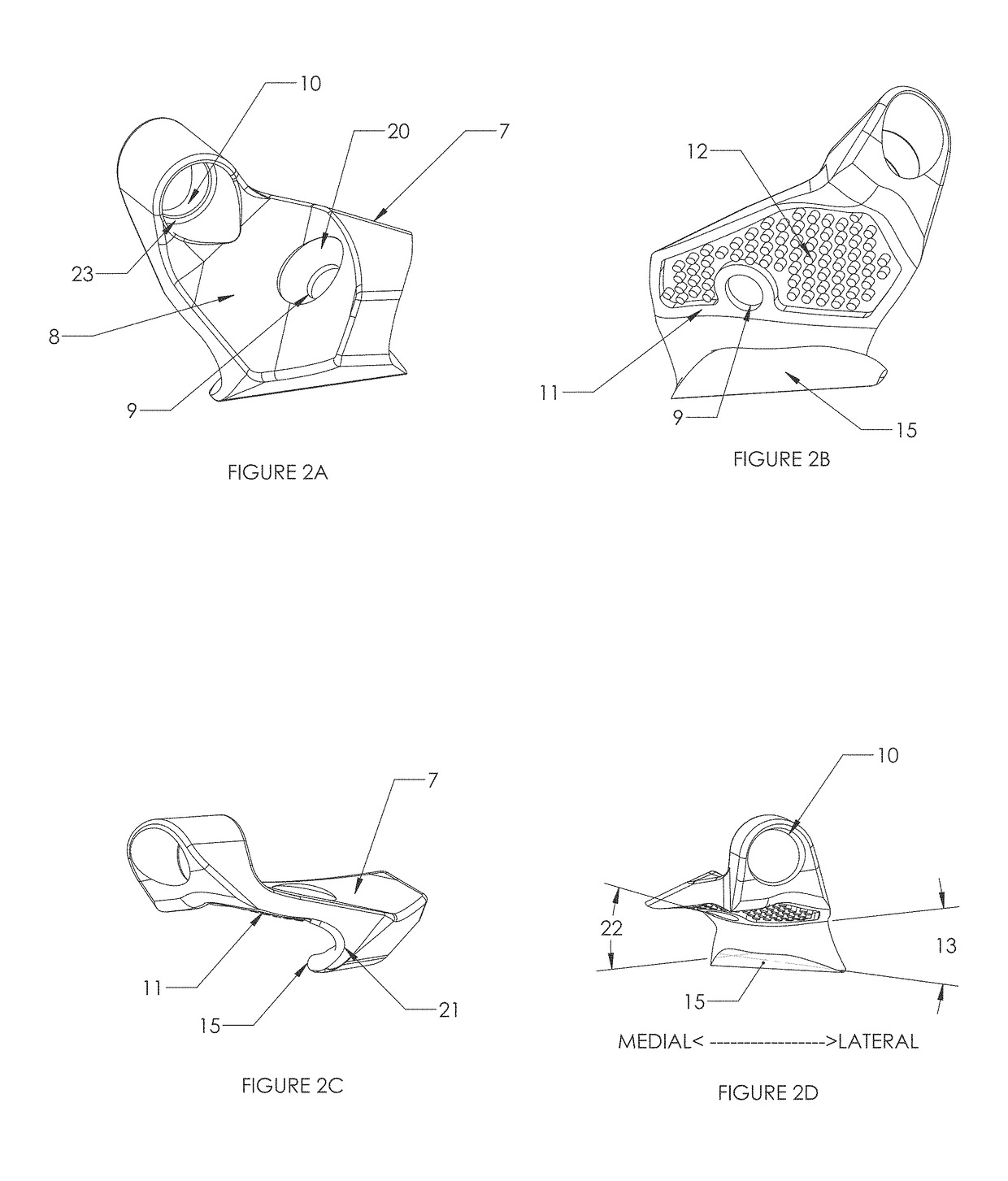 Pars Interarticularis Fracture Device