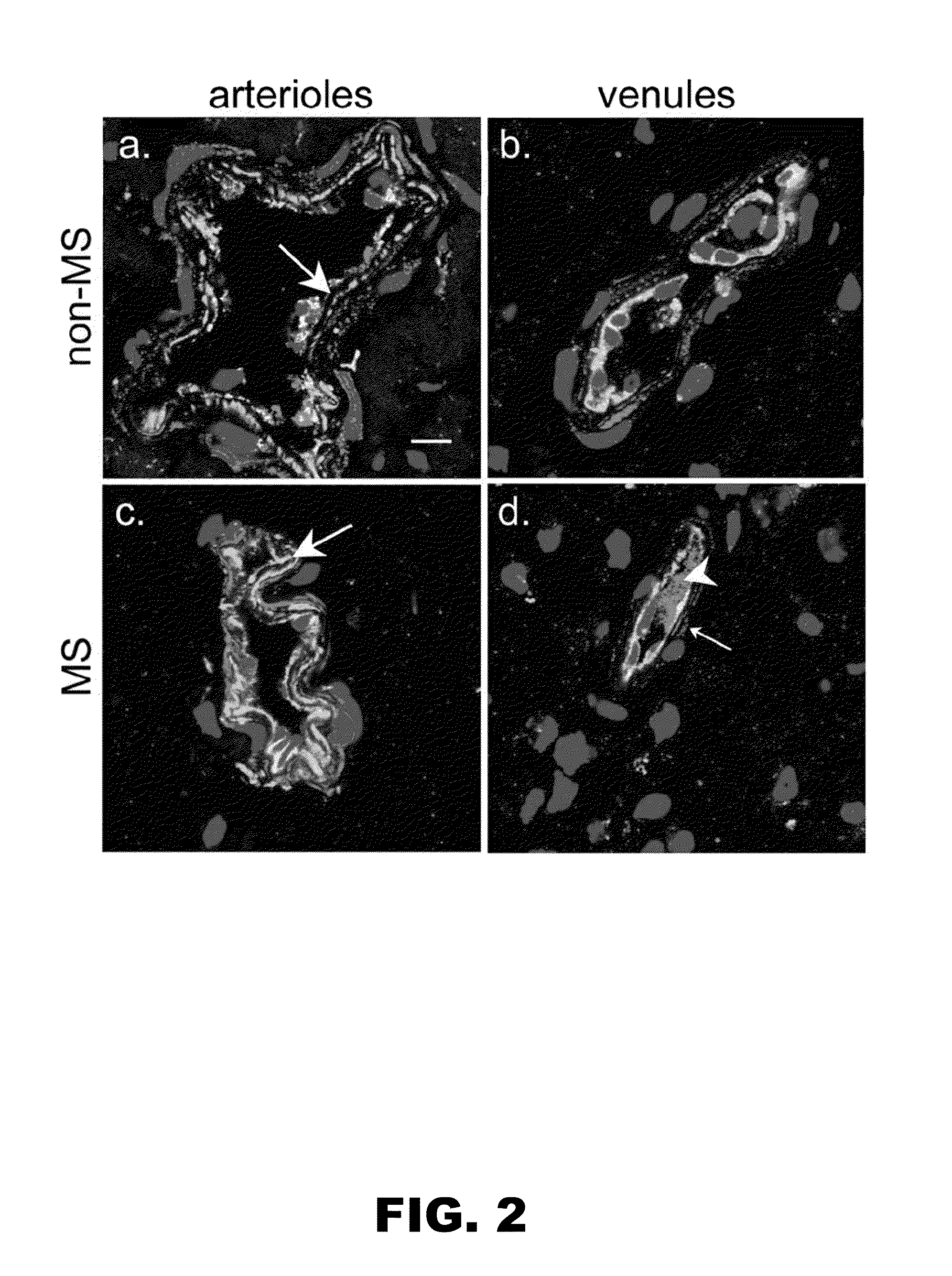 Method for detecting inflammatory disorders of the central nervous system