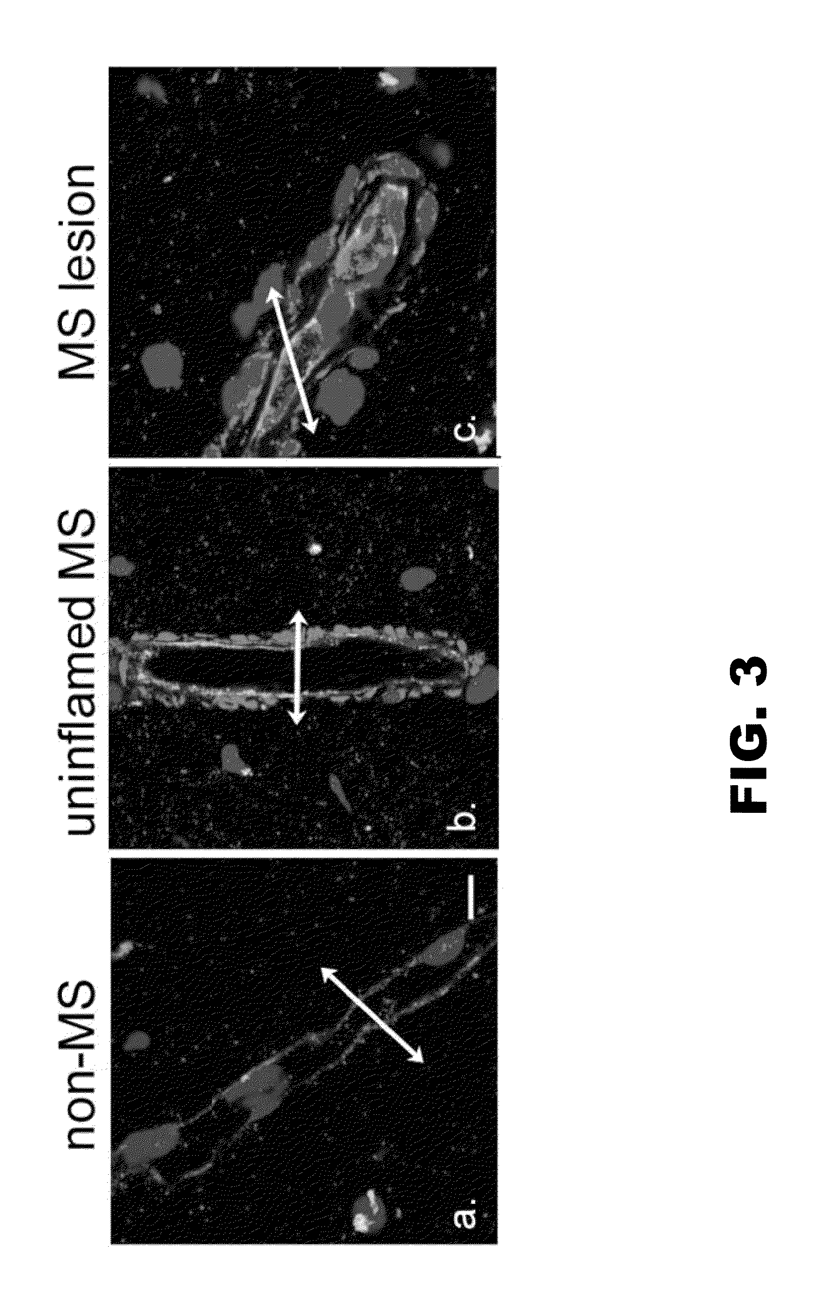 Method for detecting inflammatory disorders of the central nervous system