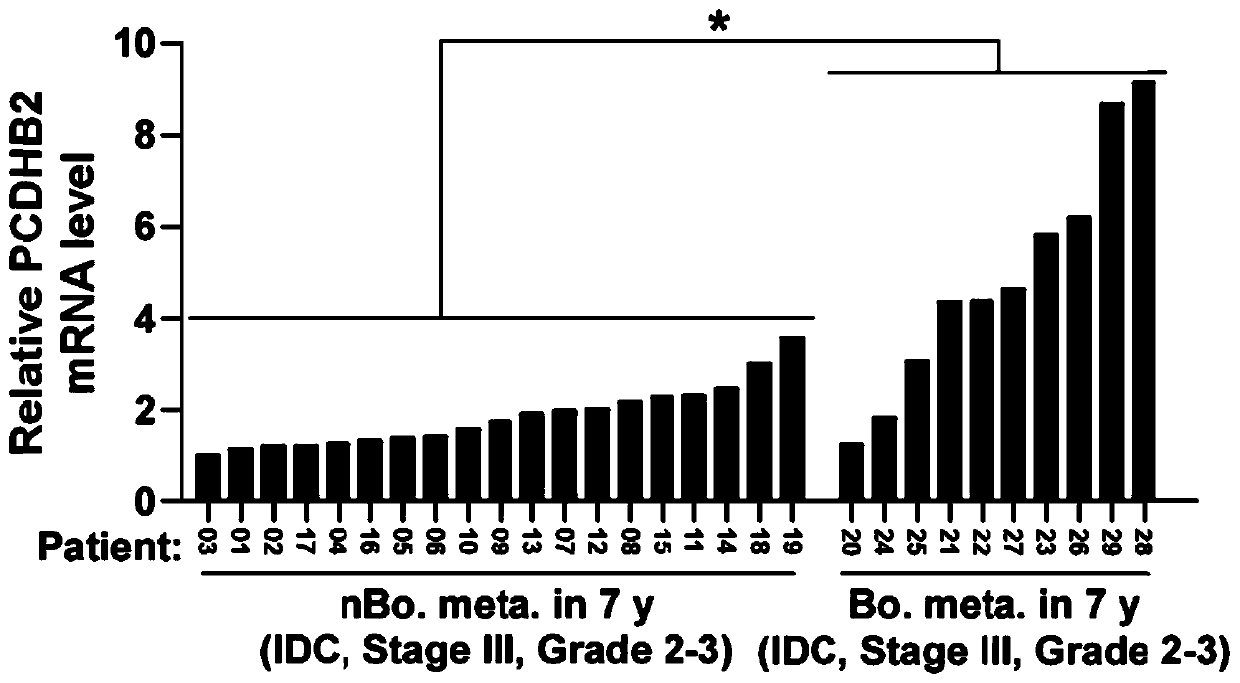 New target pcdhb2 for the diagnosis and treatment of breast cancer bone metastasis