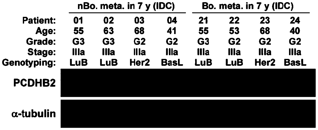 New target pcdhb2 for the diagnosis and treatment of breast cancer bone metastasis