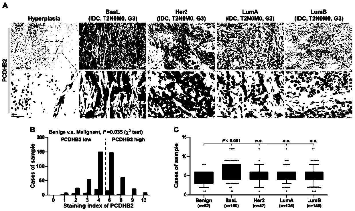 New target pcdhb2 for the diagnosis and treatment of breast cancer bone metastasis