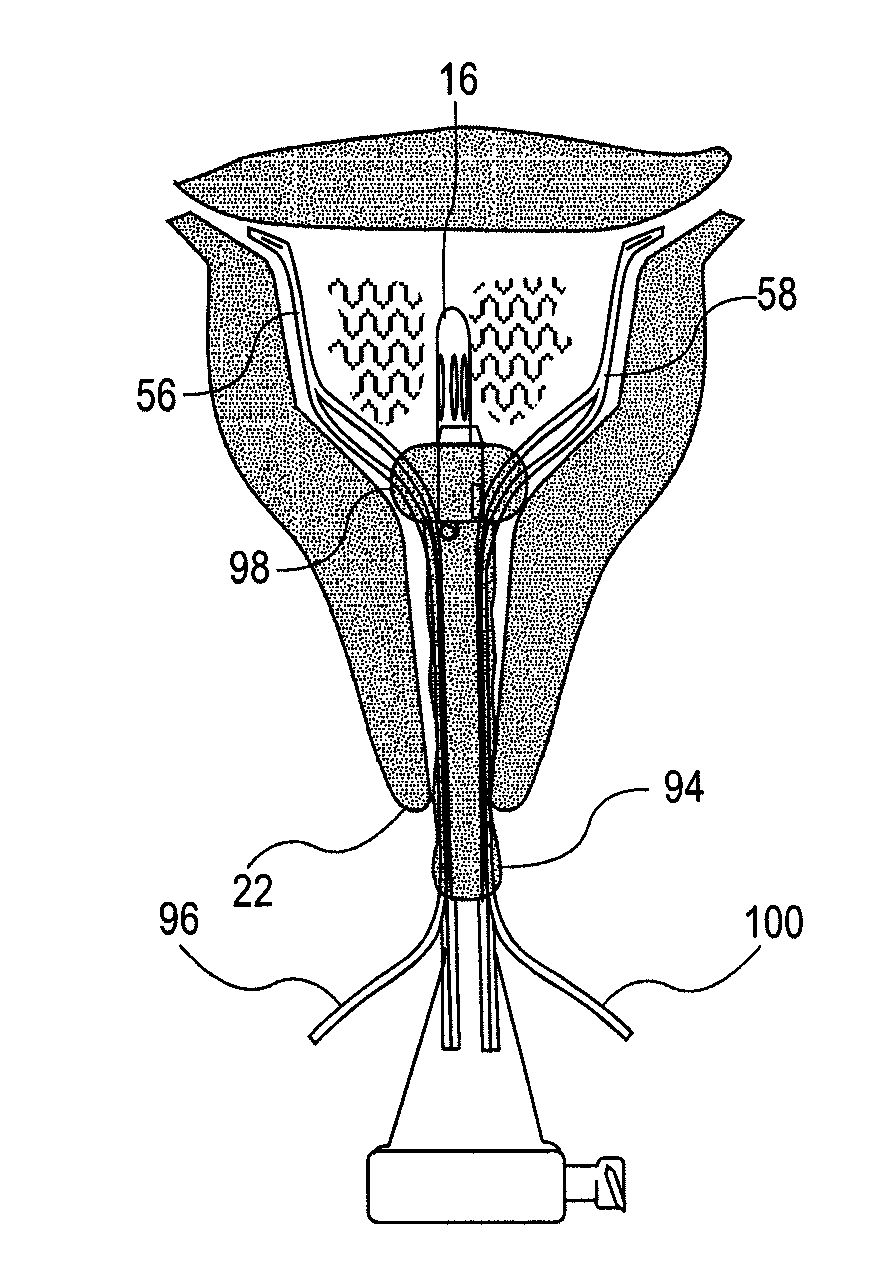 Uterine therapy device and method