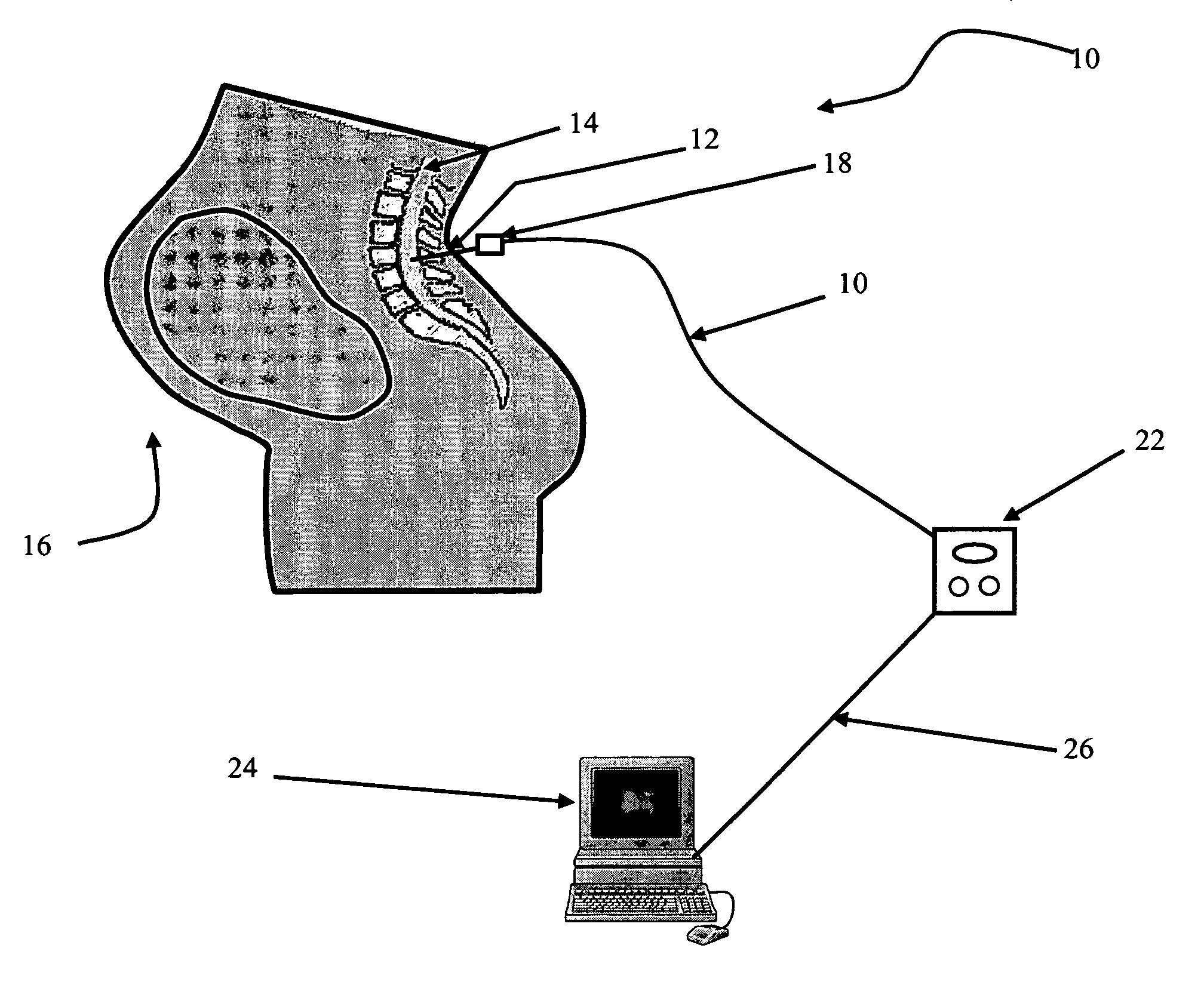 Method and apparatus for reducing preterm labor using neuromodulation