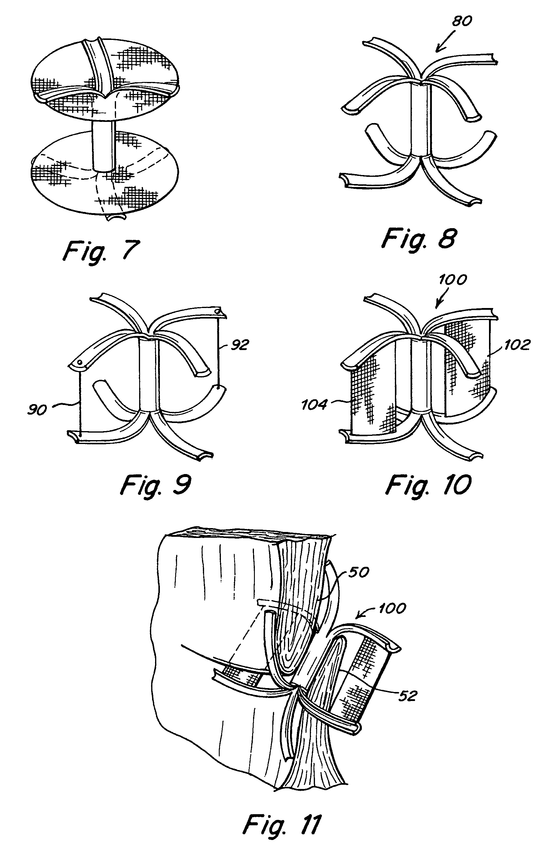 Split ends closure device