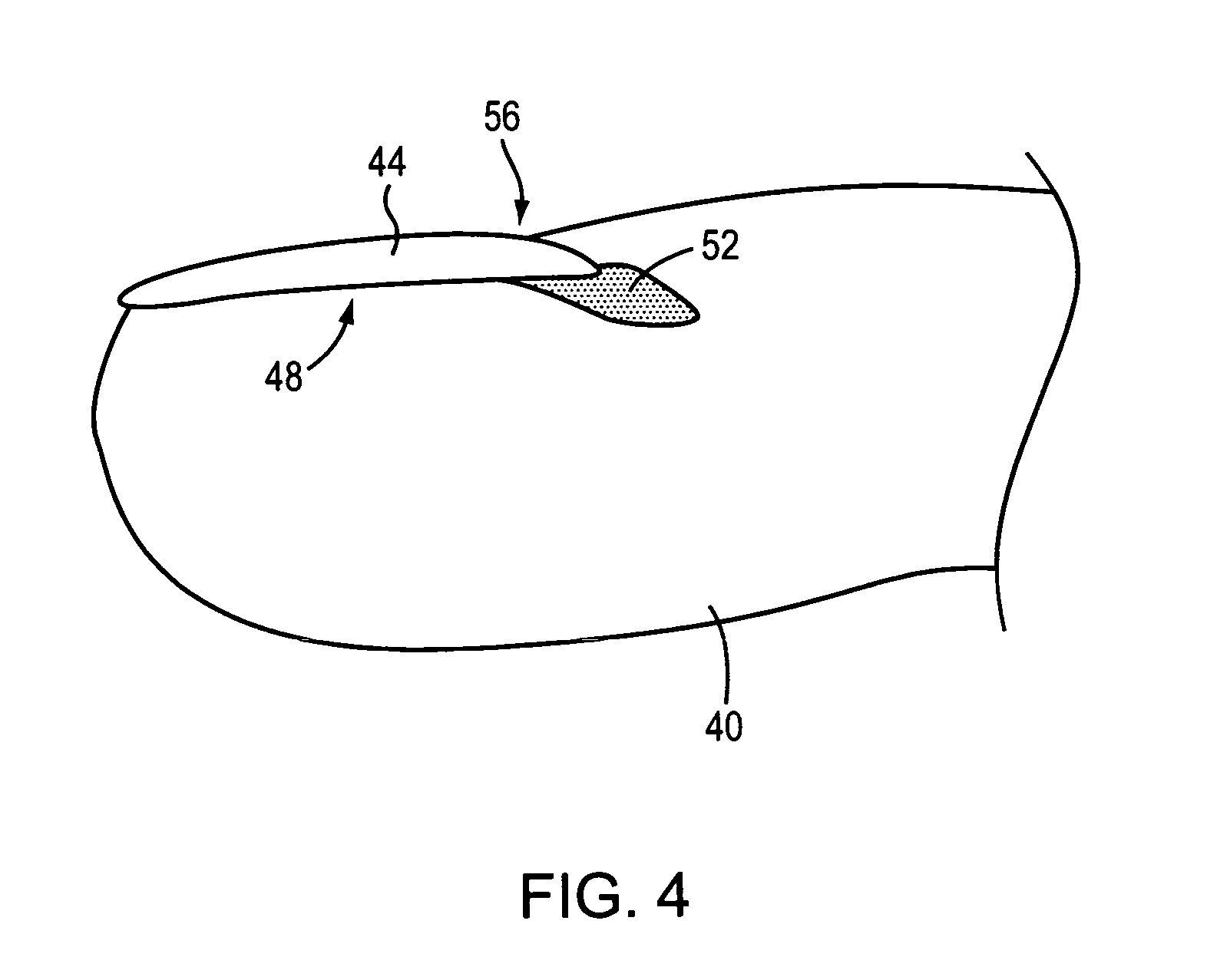 Method and apparatus for treating a diseased nail