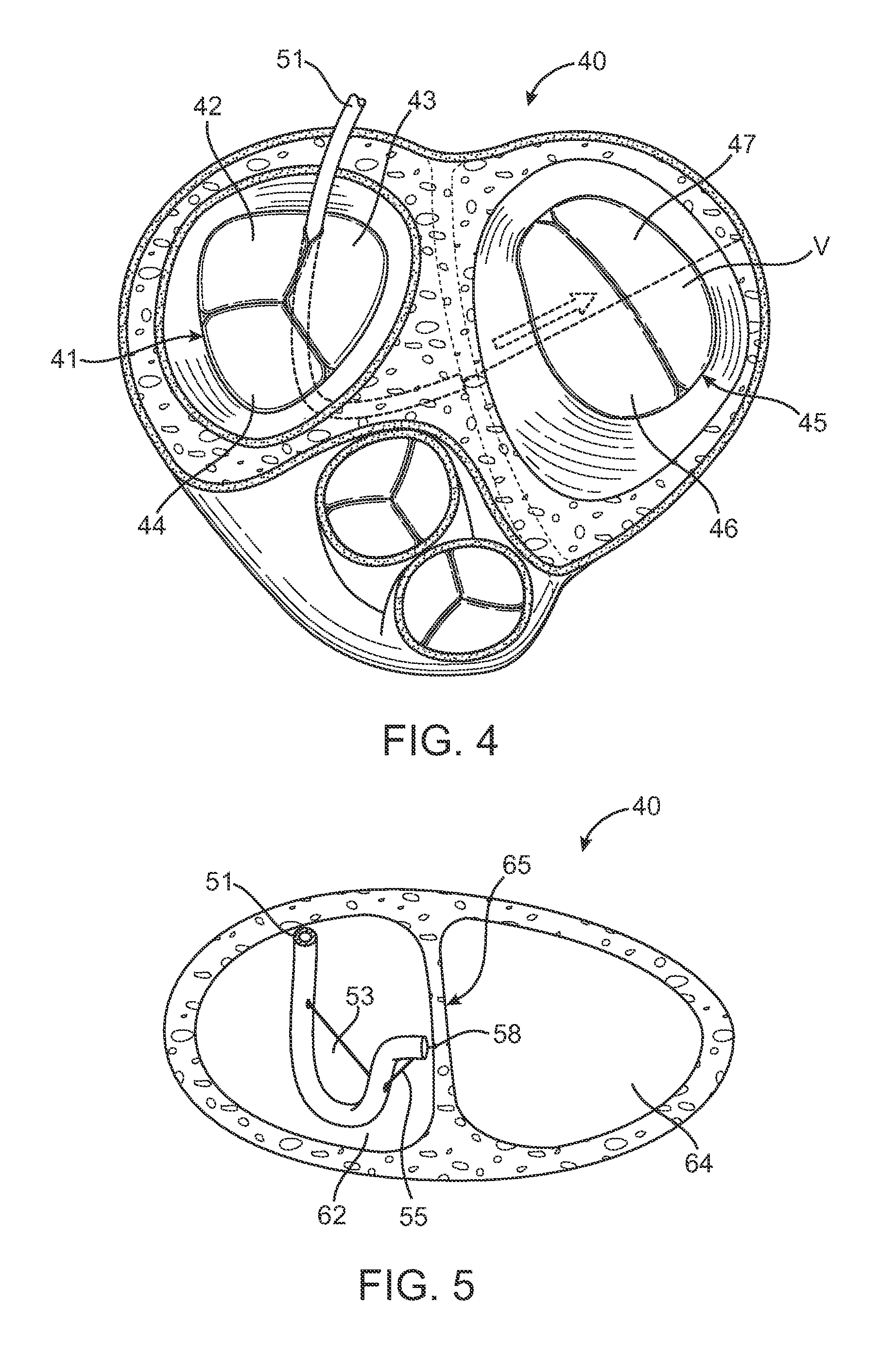Catheter Having a Selectively Formable Distal Section