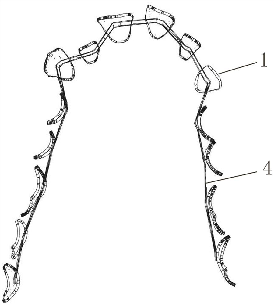 Preparation method of lingual orthodontic device for tooth correction