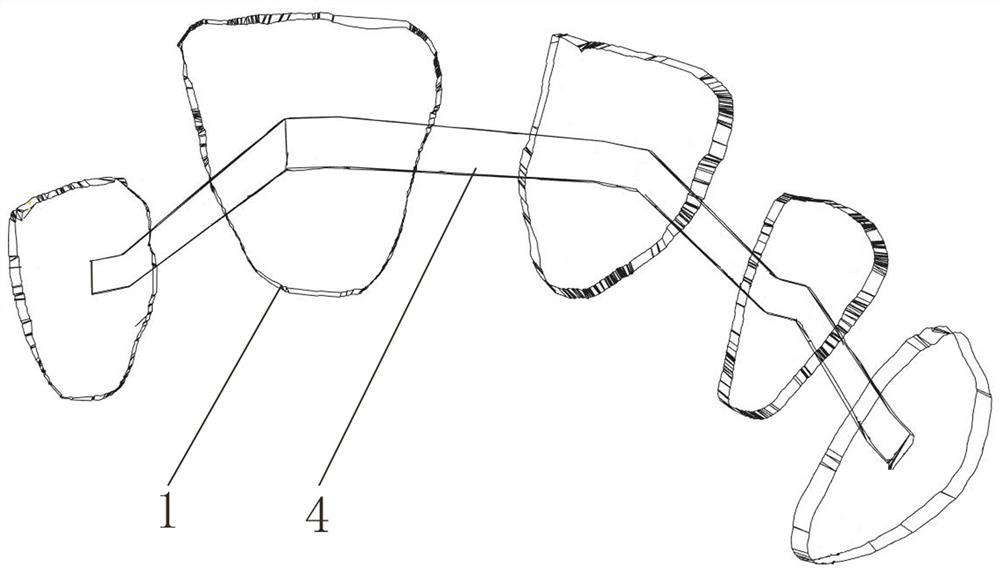 Preparation method of lingual orthodontic device for tooth correction