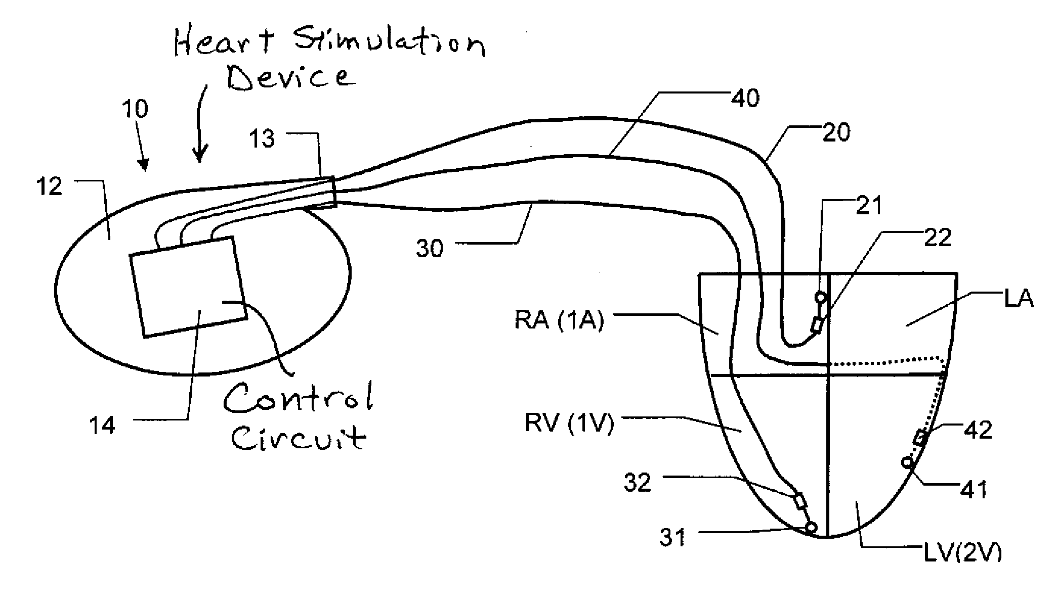 Implantable Heart Stimulation Device and Method