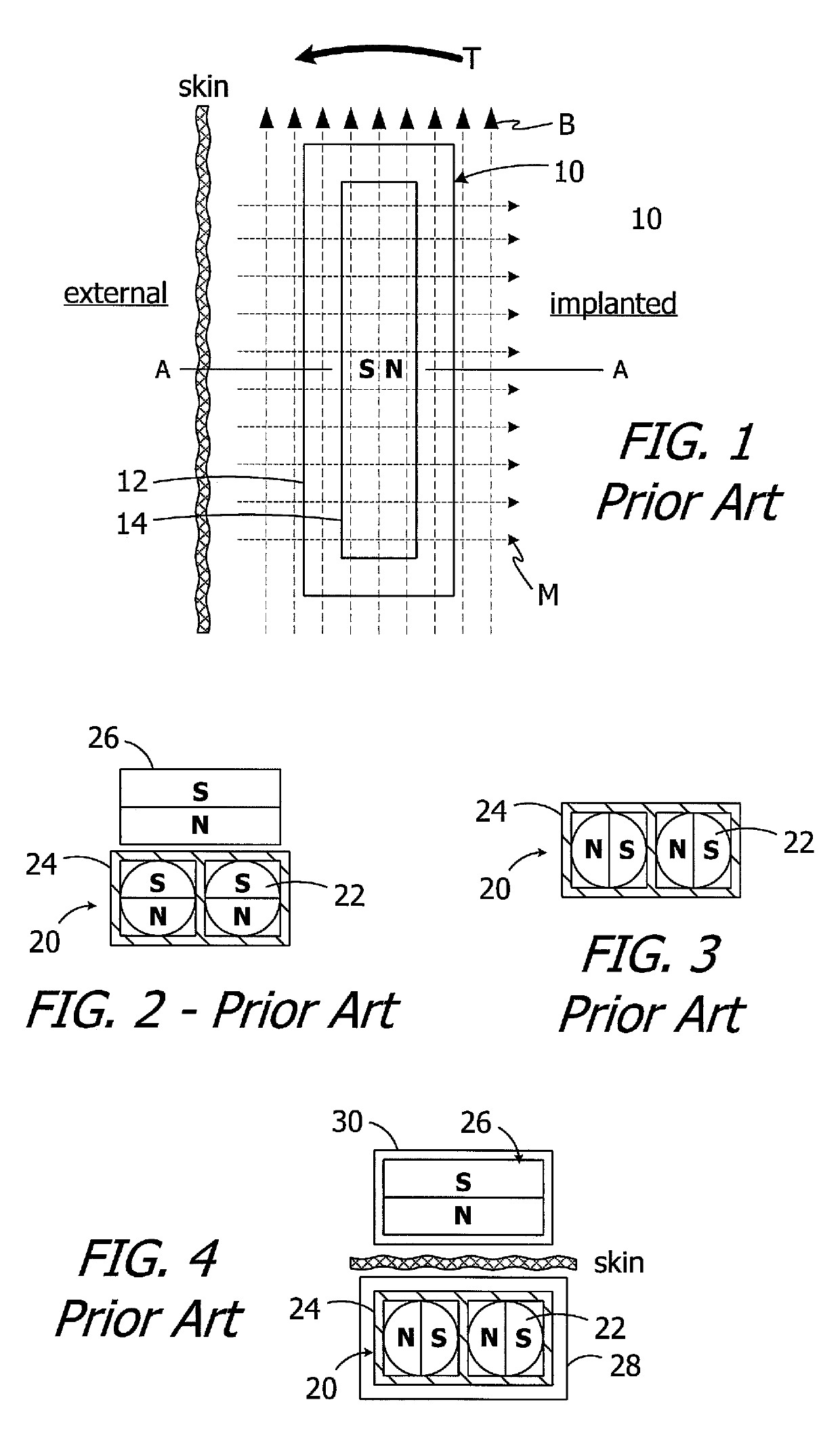 Cochlear implants having MRI-compatible magnet apparatus and associated methods