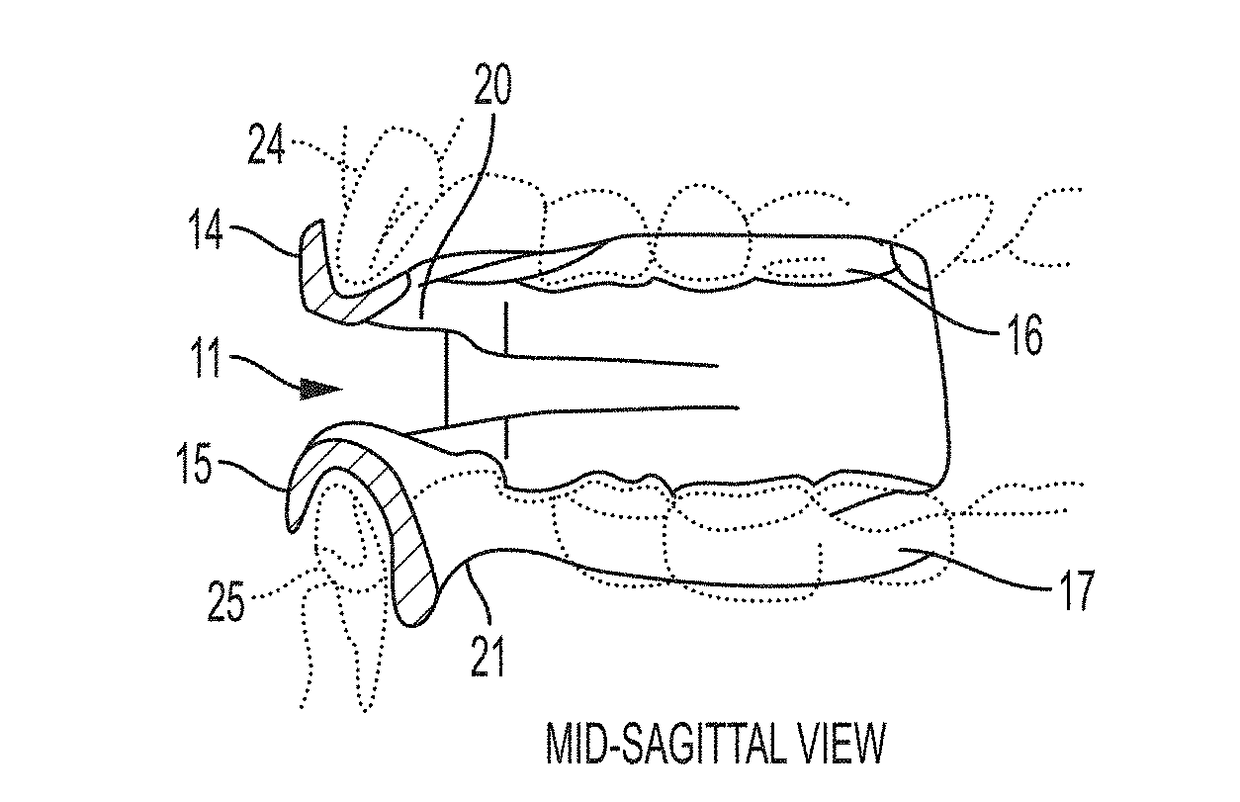 Low profile articulation jaw joint stabilizer device