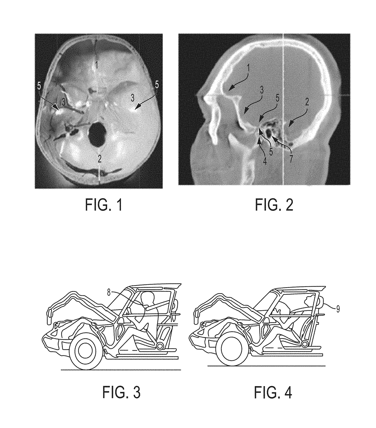 Low profile articulation jaw joint stabilizer device