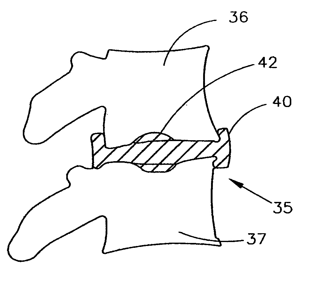 Artificial intervertebral disc