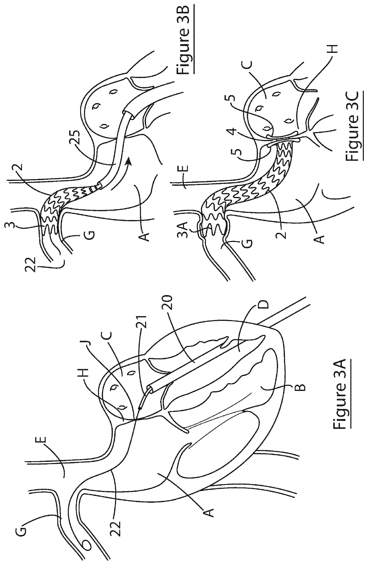 Shunting device