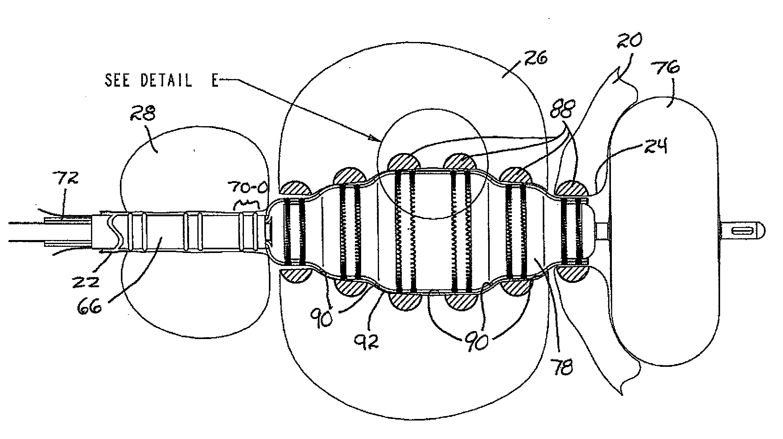 Method and apparatus for remodeling/profiling a tissue lumen, particularly in the urethral lumen in the prostate gland