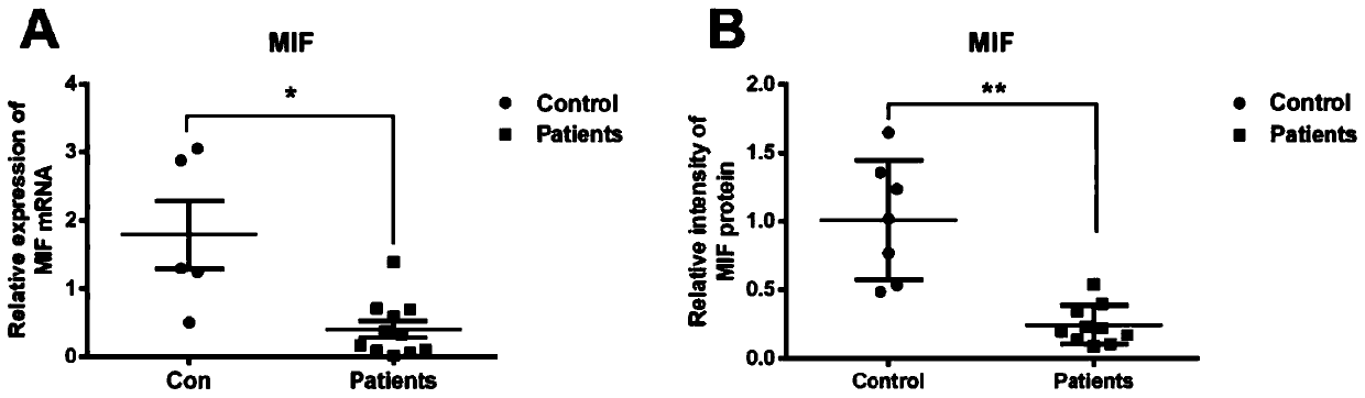 Application of MIF (migratory inhibitory factor) to preparation of product for diagnosing steroid-induced avascular necrosis of femoral head