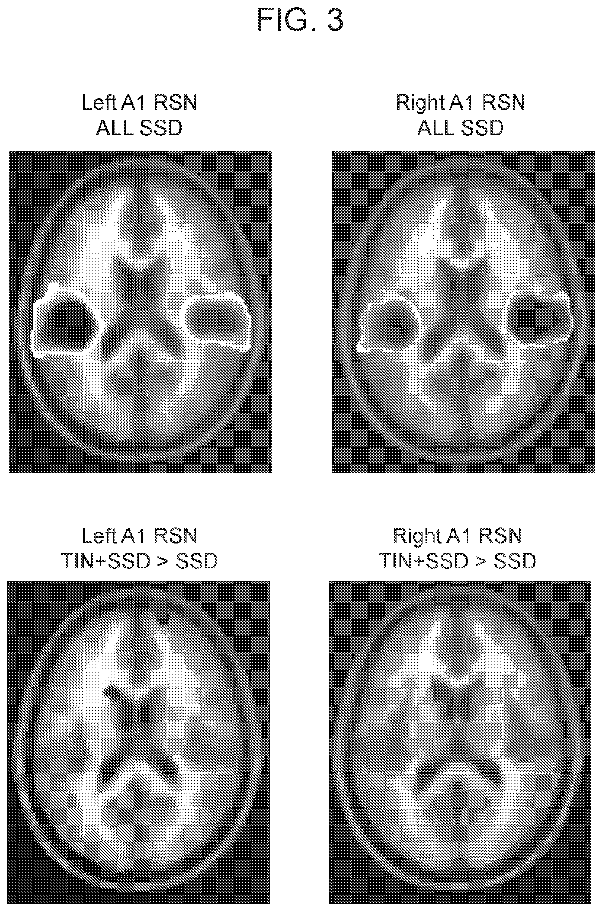 Multimodal Neuroimaging-Based Diagnostic Systems and Methods for Detecting Tinnitus