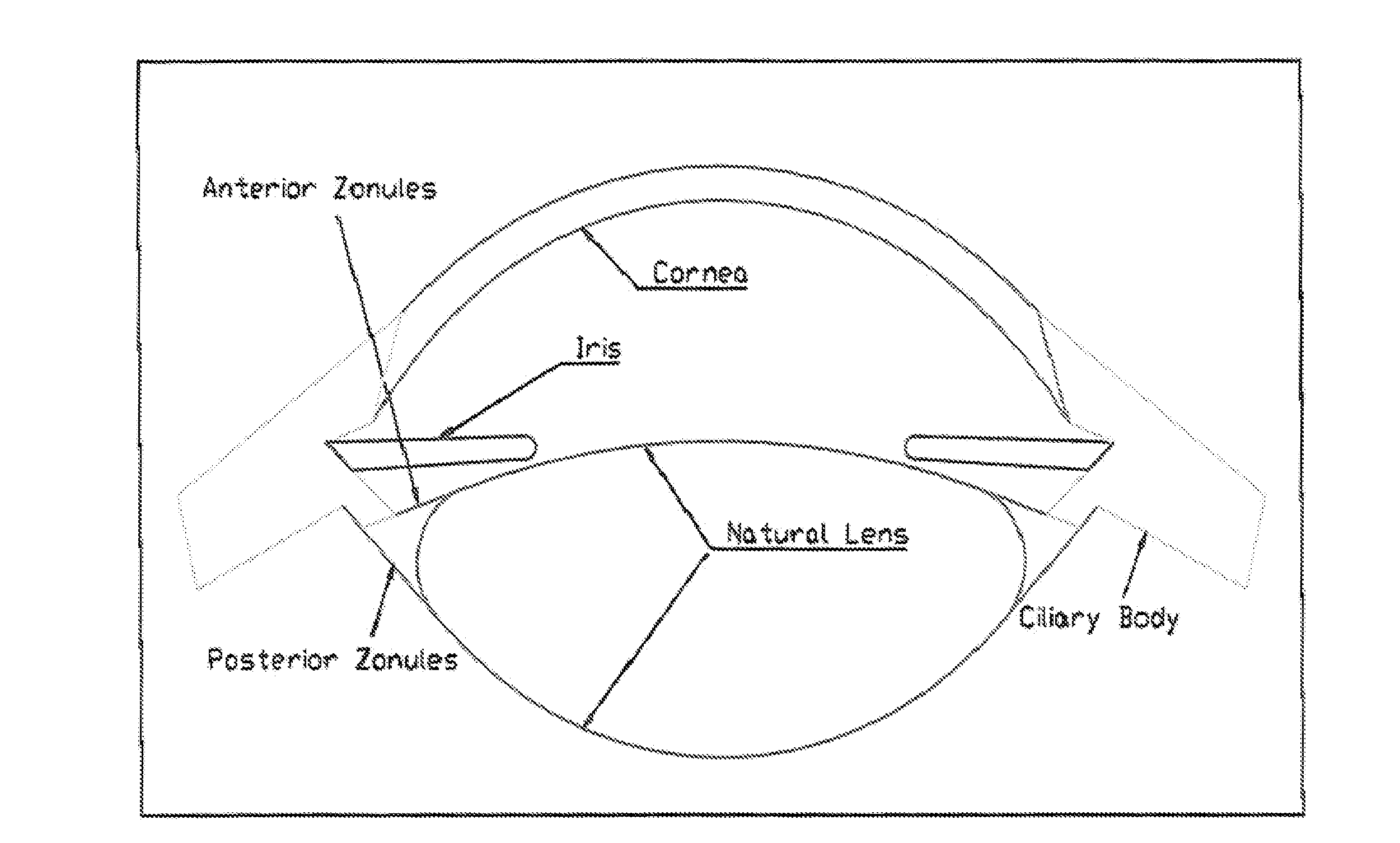 Model of accommodative intraocular lens